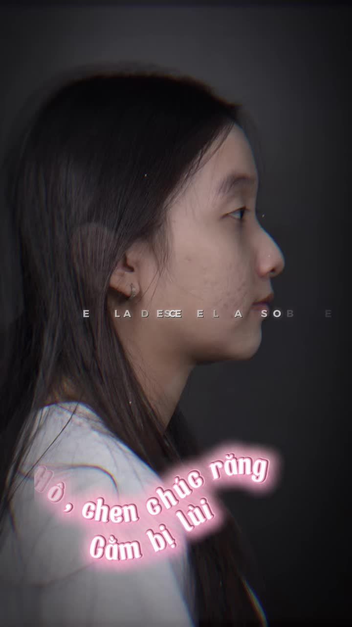 Ca chỉnh nha có chỉ định nhổ 4 răng số 4 để giảm hô và sắp đều răng.