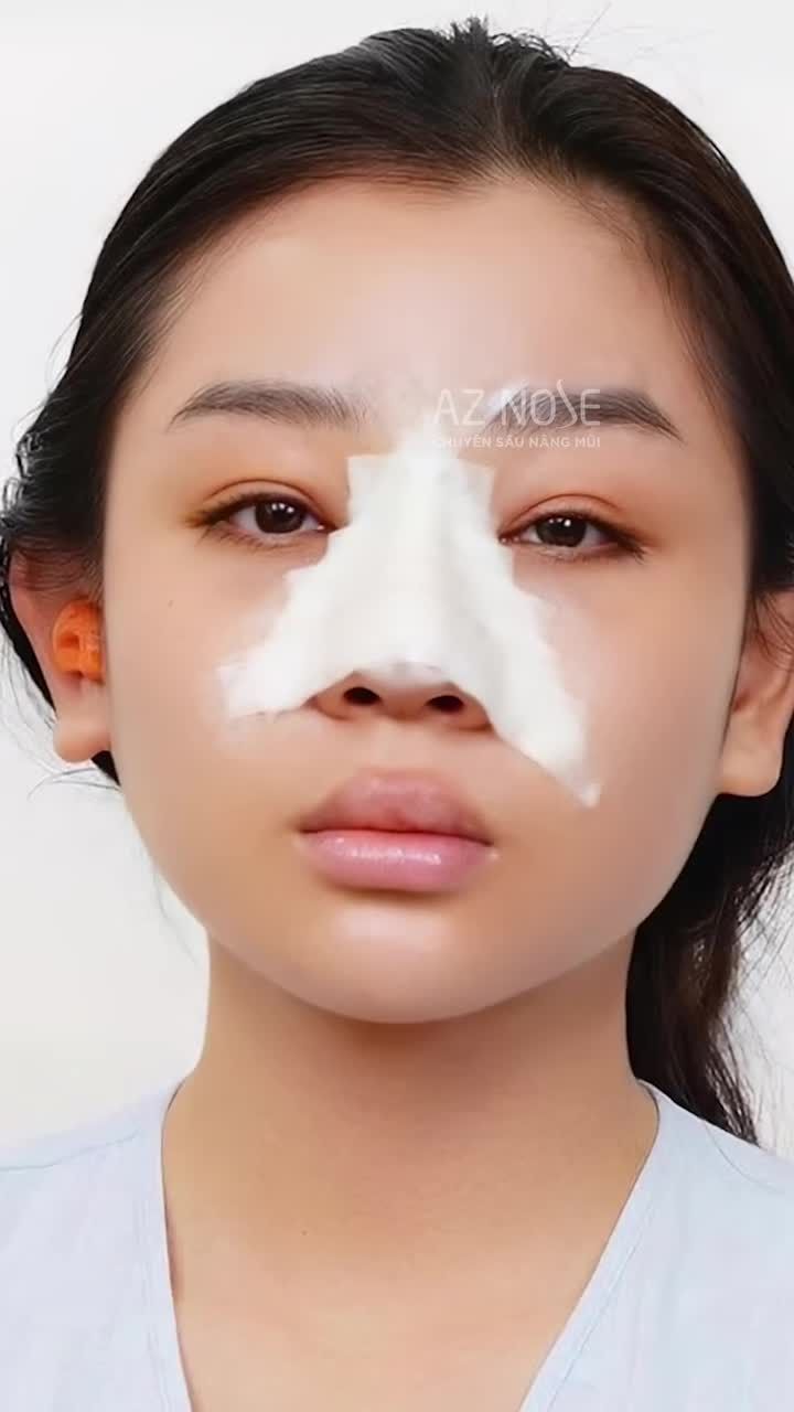 Sự khác biệt giữa "vừa tháo nẹp" và "sau 4 tháng"