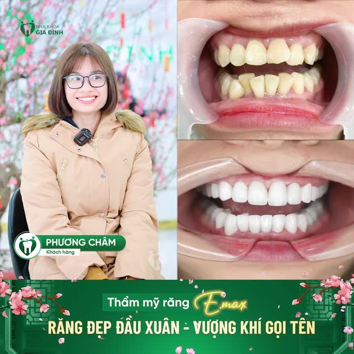 RĂNG ĐẸP ĐẦU XUÂN - VƯỢNG KHÍ GỌI TÊN
