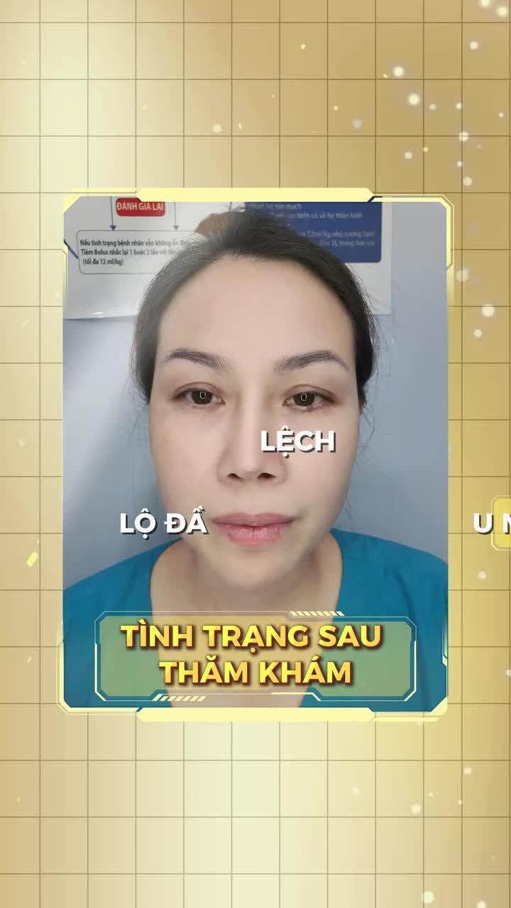 Nên dùng chất liệu gì để tránh lộ đầu mũi?