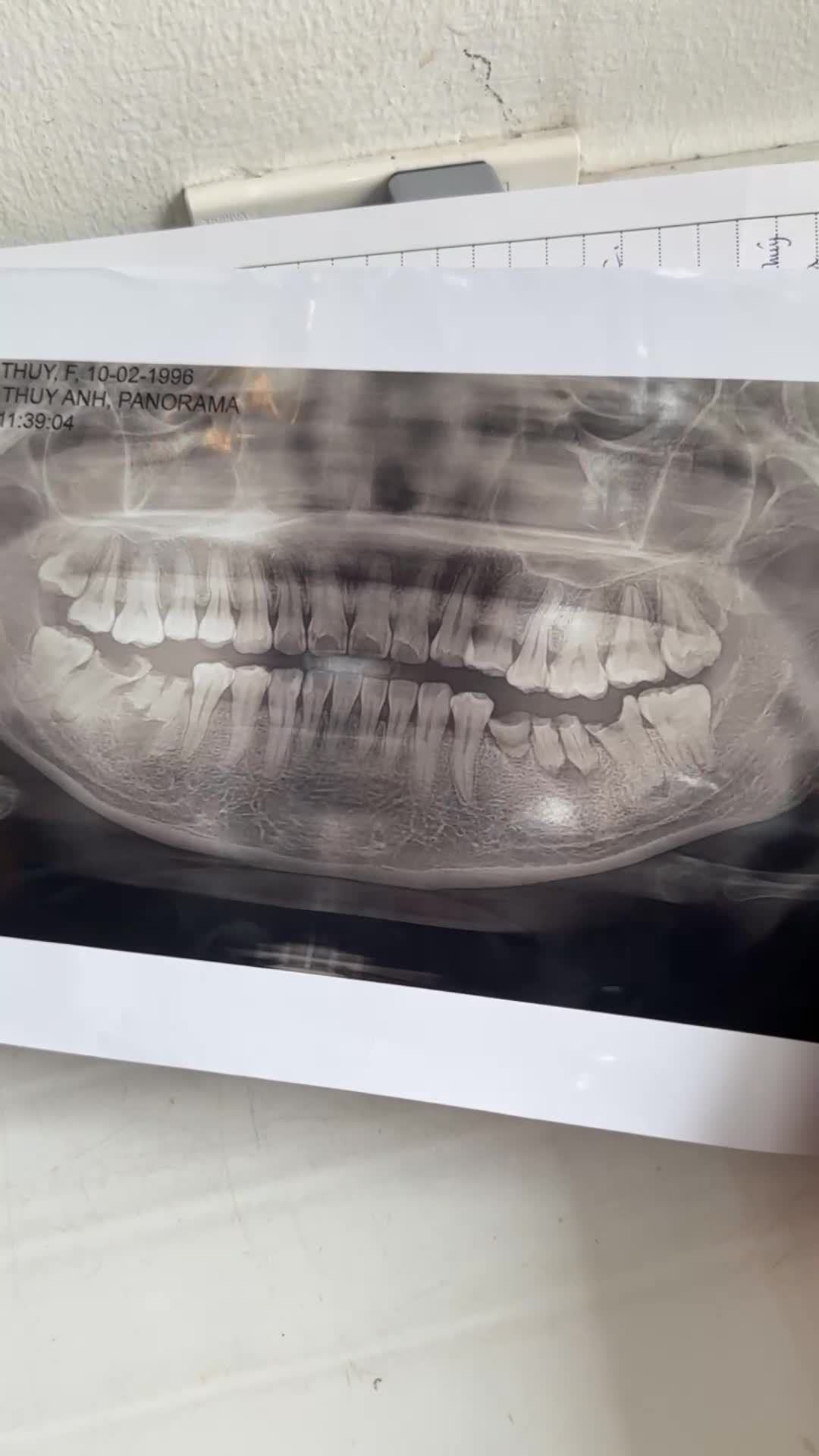 Ca nhổ răng khôn số 48 mọc kẹt, gây dắt thức ăn và khó chịu cho khách hàng và các chân răng sâu hỏng.