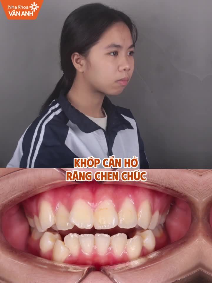 Niềng răng đúng phác đồ cá nhân hóa có thể thay đổi như thế nào?