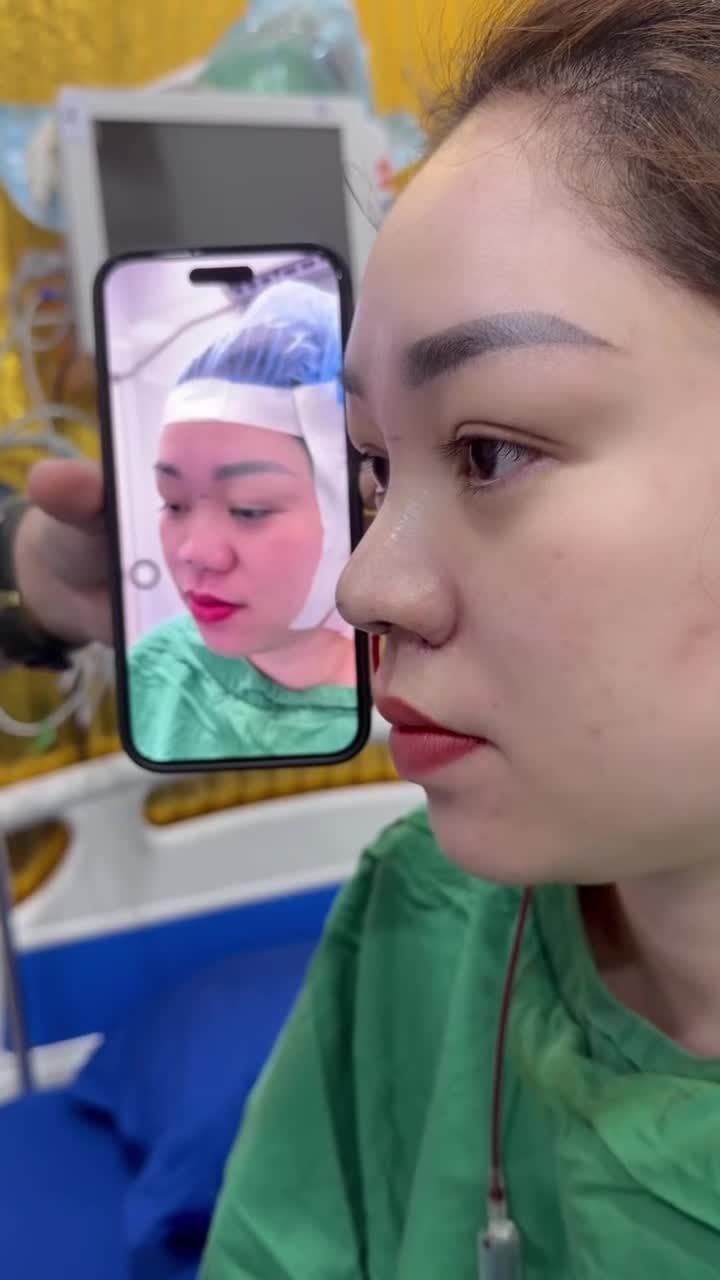 Ngay bây giờ ekip bác sĩ vừa thực hiện xong case mũi thứ 4 trong ngày tại chuyến đi công tác Sài Gòn hôm nay.