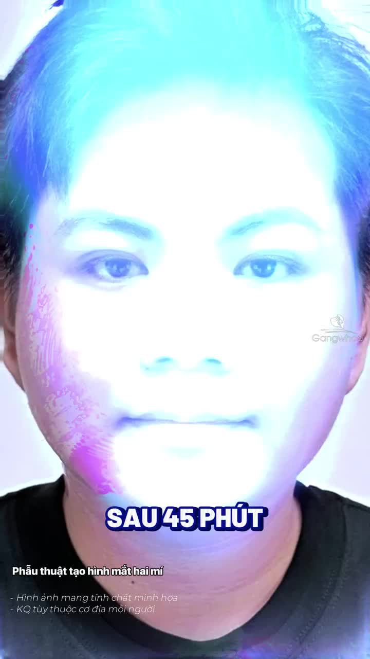 Phương pháp tạo hình mắt hai mí dành cho các bạn nam chỉ khoảng 7 ngày để hồi phục. Kết quả hài hòa - tự nhiên, không tốn nhiều thời gian nghỉ dưỡng