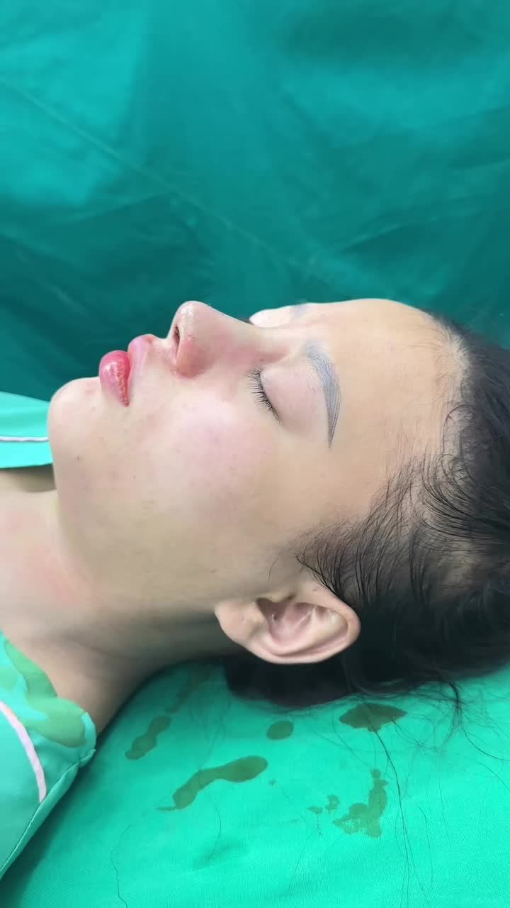 NÂNG MŨI BỌC SỤN - DÁNG MŨI ĐẸP TỰ NHIÊN - GIÁ CHỈ 17TR!!