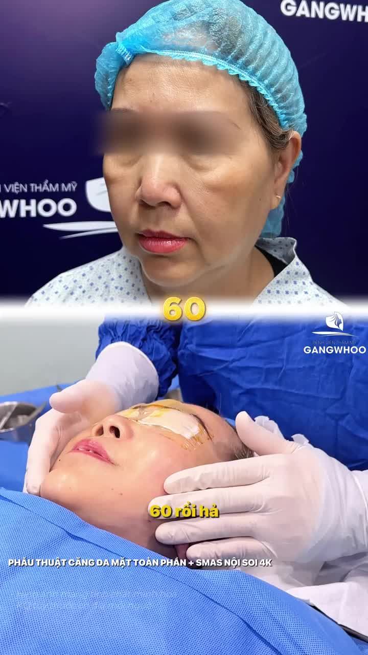 Kết quả ngay sau phẫu thuật căng da mặt toàn phần + Smas nội soi 4K tại Bệnh viện thẩm mỹ Gangwhoo