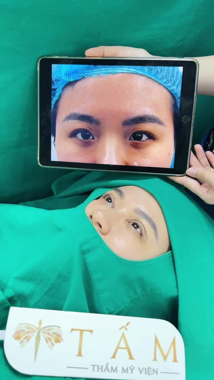 Ngắm kết quả xinh đẹp của chị gái suốt 2 năm, cuối cùng cô nàng cũng quyết định đến TMV Tấm để thay đổi đôi mắt của mình.