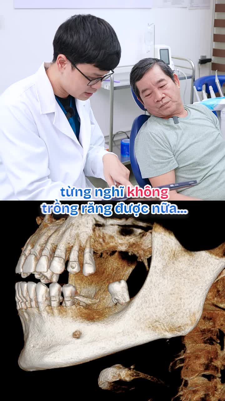 CHÚ LIỄU MẤT 7 RĂNG, BỊ TIÊU XƯƠNG NẶNG  -  TỪNG NGHĨ CHẮC KHÔNG TRỒNG RĂNG ĐƯỢC