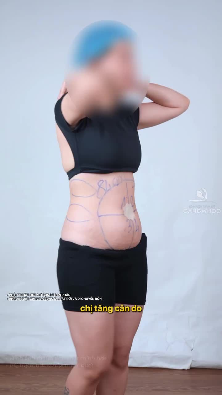Hậu phẫu sau 1 ngày chị khách nhà Gangwhoo làm combo giảm mỡ và căng da bụng