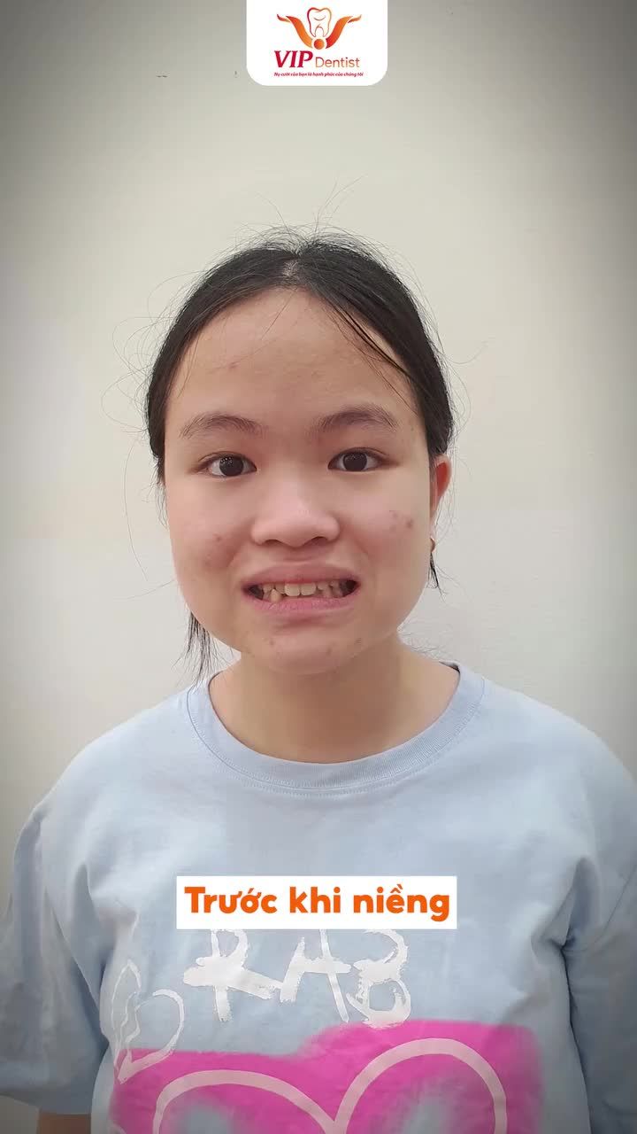 Bạn Hương Giang trước khi đến VIP Dentist gặp tình trạng răng khấp khểnh nặng, sai khớp cắn.