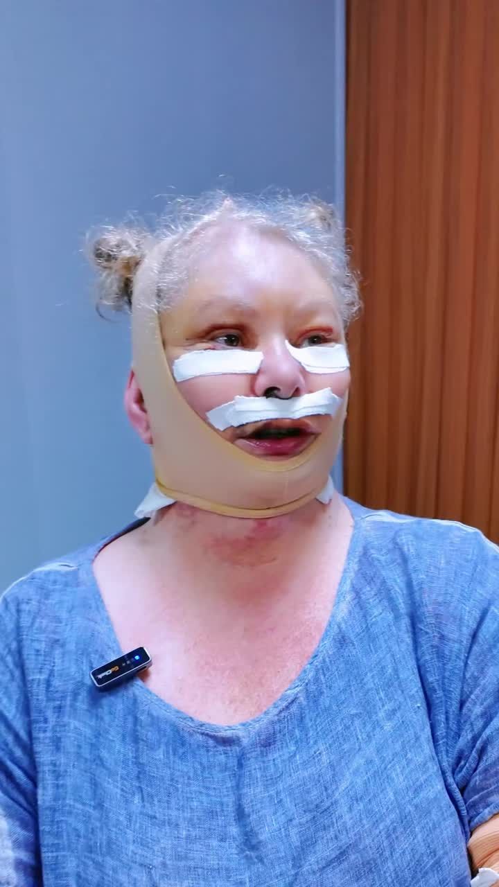 KHÁCH HÀNG ÚC TRẺ HÓA TOÀN DIỆN – DIỆN MẠO THAY ĐỔI NGAY SAU PHẪU THUẬT CĂNG DA MẶT TOÀN PHẦN + SMAS NỘI SOI 4K!