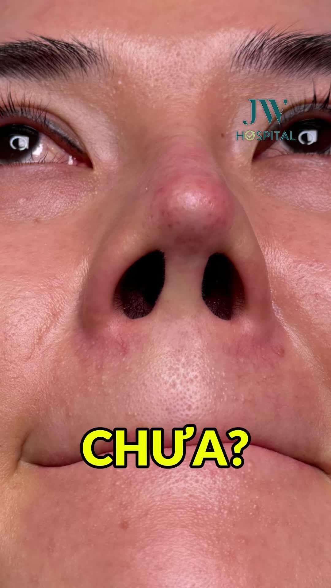 RÚT SỤN - NÂNG MŨI S LINE CỨU HOTGIRL 9X SUÝT T.H.Ủ.N.G MŨI VÌ CAO TÂY