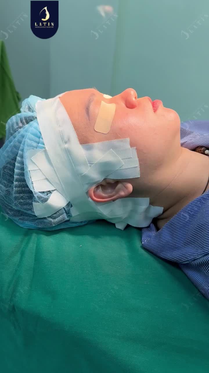 TẠM BIỆT MŨI THÔ BÈ - CHÀO NĂM MỚI VỚI DÁNG MŨI THON XINH