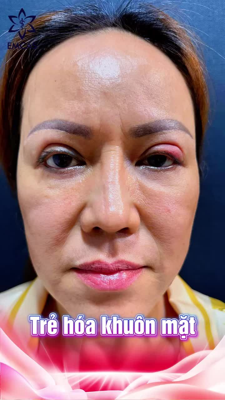 Xóa tan dấu hiệu tuổi tác với Căng da mặt ADM.