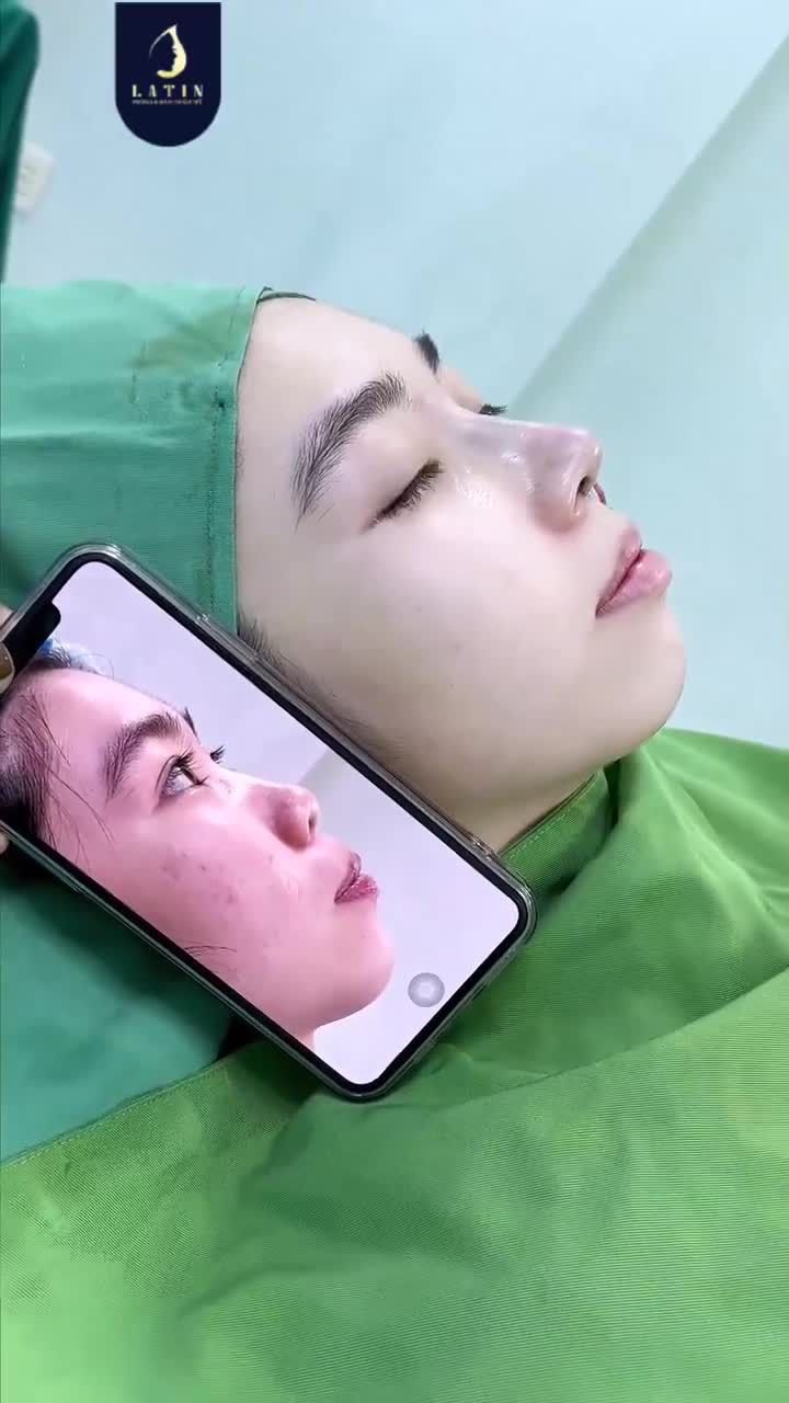 CA MŨI CẤU TRÚC SỤN TAI THU NỀN XƯƠNG CHO GÁI