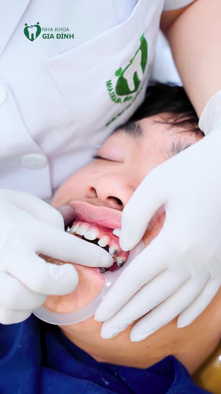 CA NIỀNG RĂNG ĐẦU XUÂN NĂM MỚI TẠI NHA KHOA GIA ĐÌNH CƠ SỞ 178 NGÔ GIA TỰ