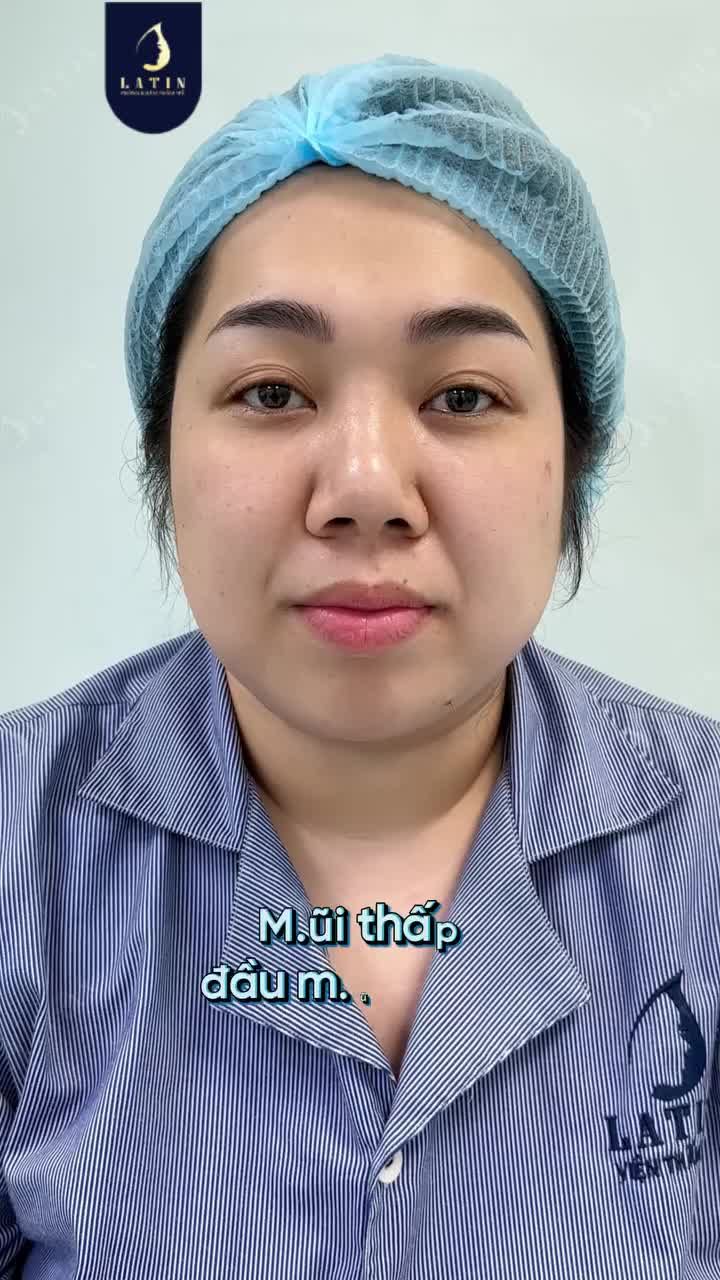 HÀNH TRÌNH SỬA LẠI MŨI CẮT MÍ SAU 10 NGÀY?