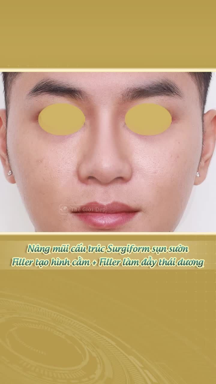 Một combo – Ba điểm chạm giúp gương mặt rõ khối, thu hút hơn ở góc nghiêng