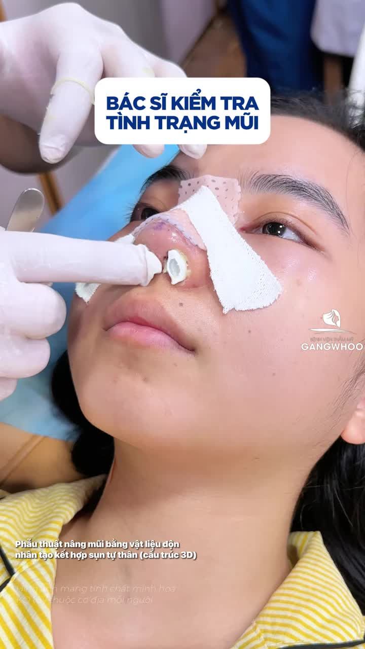 Quy trình rút ống birocel chuẩn y khoa tại BVTM Gangwhoo