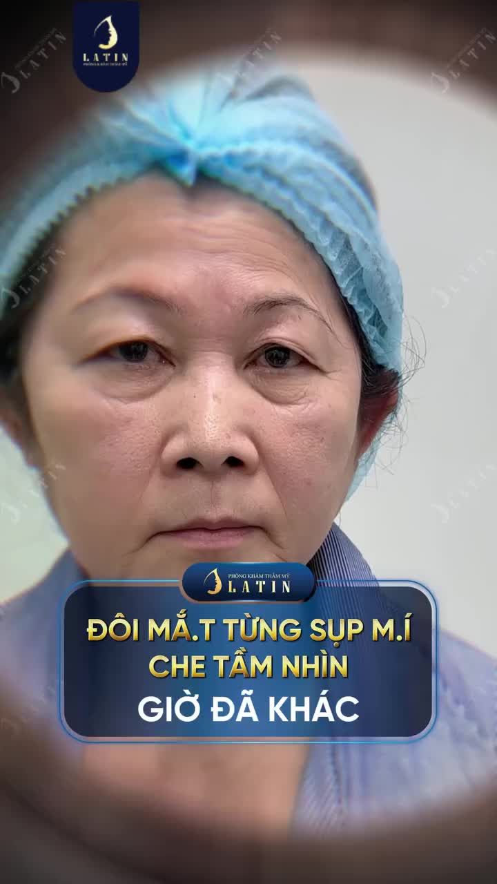 ĐÔI MẮT TỪNG SỤP MÍ CHE TẦM NHÌN GIỜ ĐÃ KHÁC