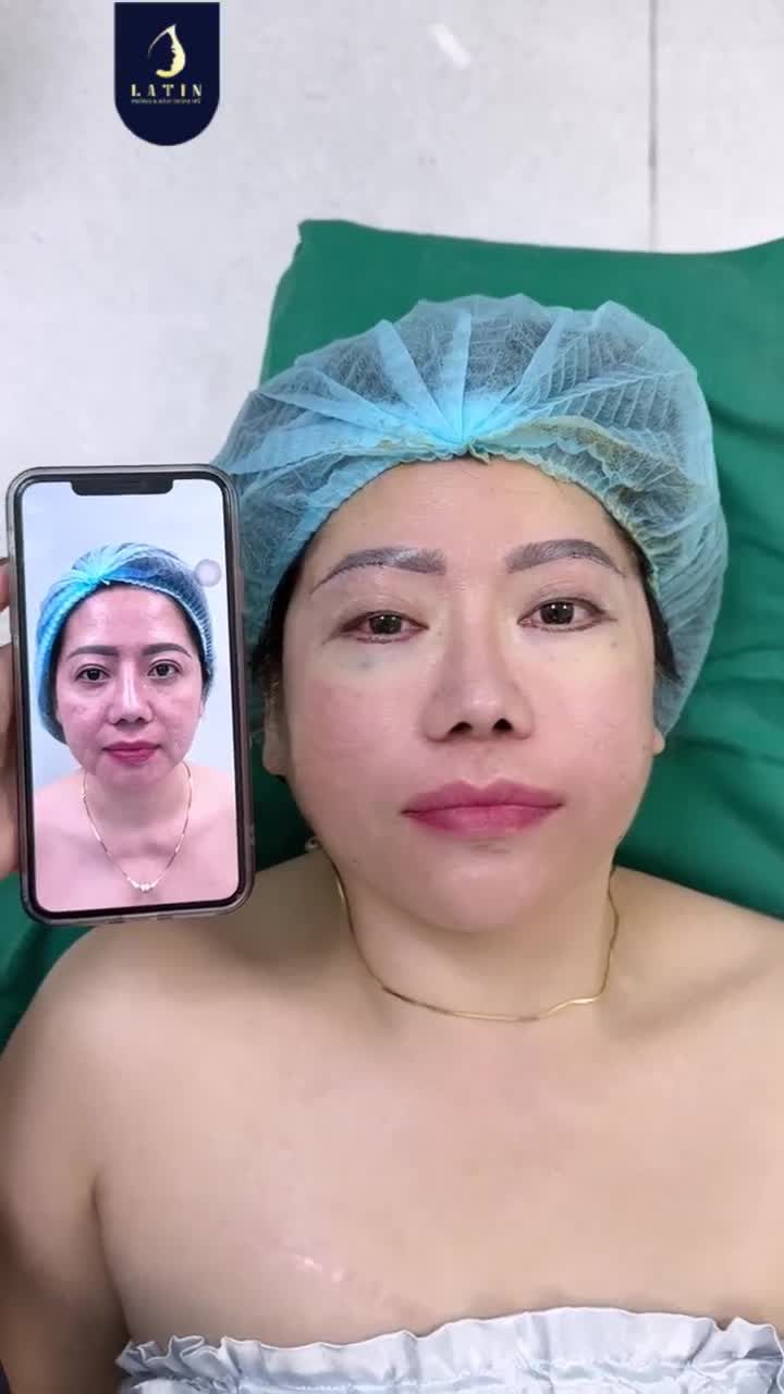 TREO NỬA CUNG MÀY + CẮT MÍ DƯỚI + CẤY MỠ MÍ DƯỚI – GIẢI PHÁP TRẺ HÓA ĐÔI MẮT TỰ NHIÊN