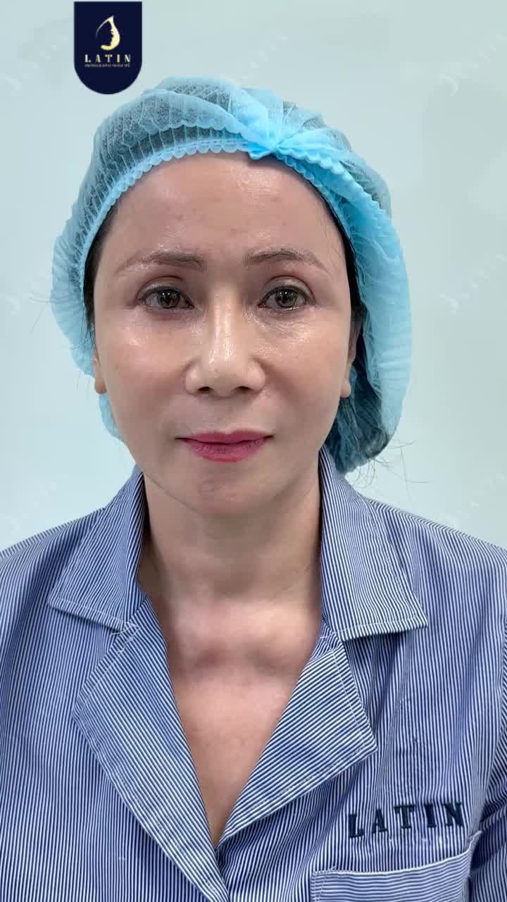 TRẺ HÓA TỨC THÌ 10 NĂM TUỔI