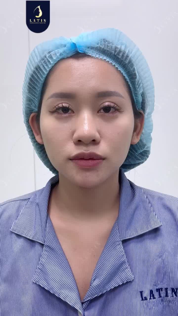 KẾT QUẢ CỦA THU NỀN XƯƠNG MŨI TẠO NÊN ĐIỂM KHÁC BIỆT RA SAO?