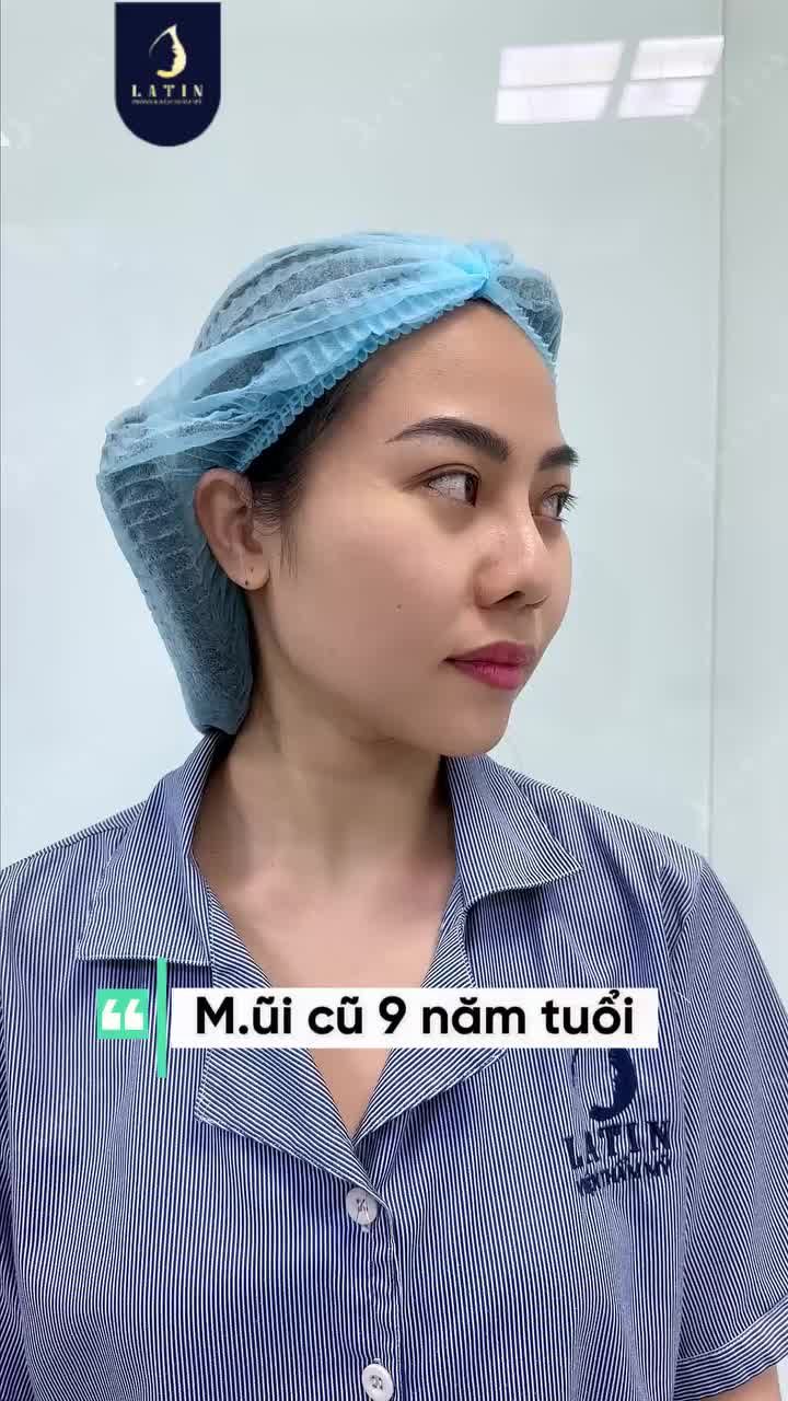 HÀNH TRÌNH TÁI CẤU TRÚC DÁNG MŨI CŨ 9 NĂM CÓ GÌ VUI?