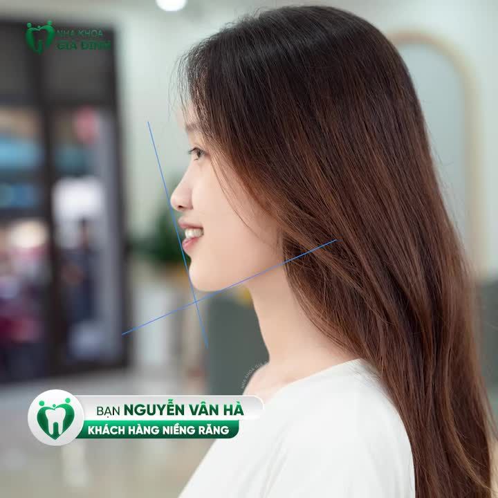 THÁNG VÀNG ƯU ĐÃI - NIỀNG RĂNG CHỈ TỪ 1 TRIỆU ĐỒNG/THÁNG