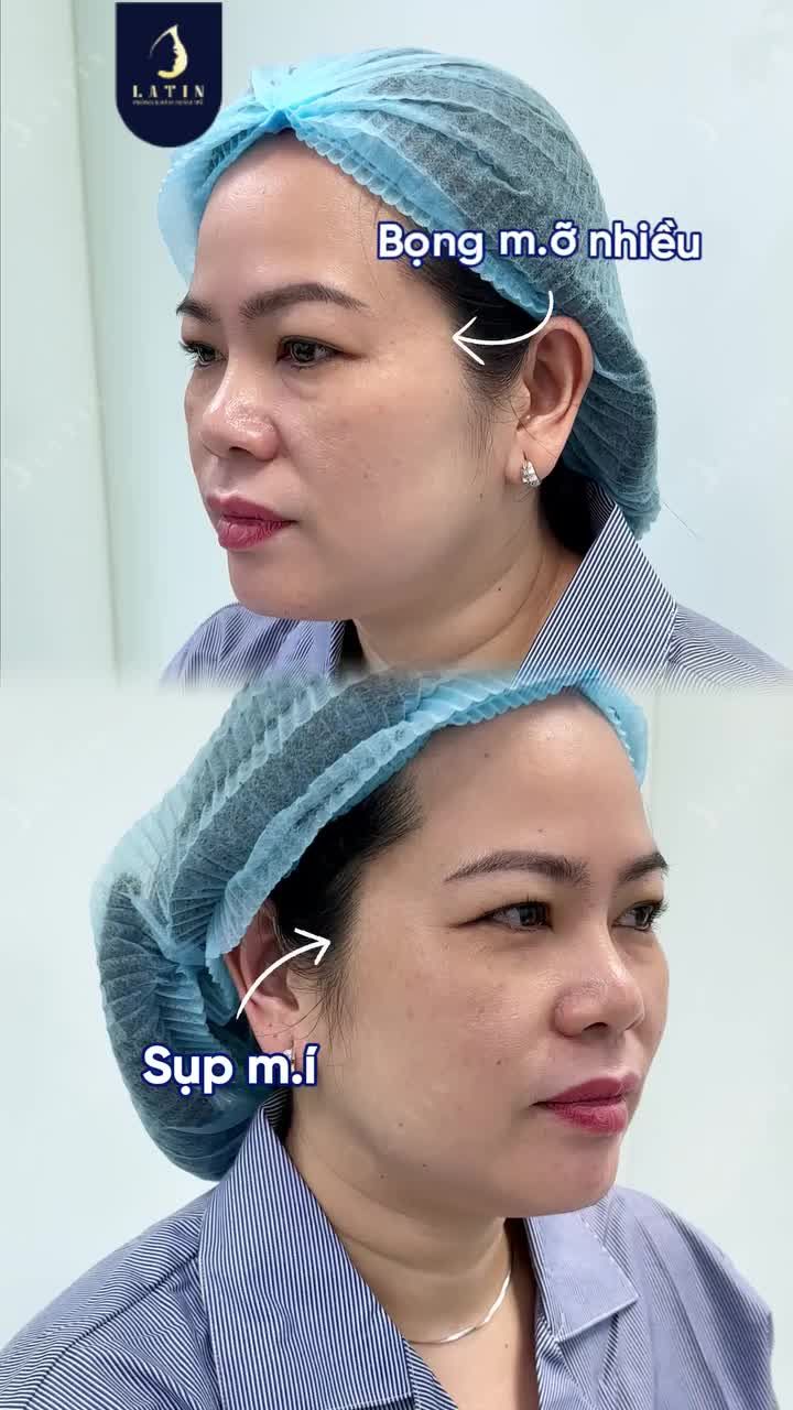 BẠN THẤY ĐÔI MẮT ẢNH HƯỞNG BAO NHIÊU % ĐẾN GƯƠNG MẶT?