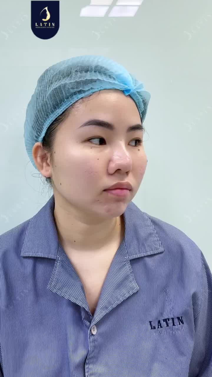 TÌM LẠI TỰ TIN CÙNG DÁNG MŨI MỚI