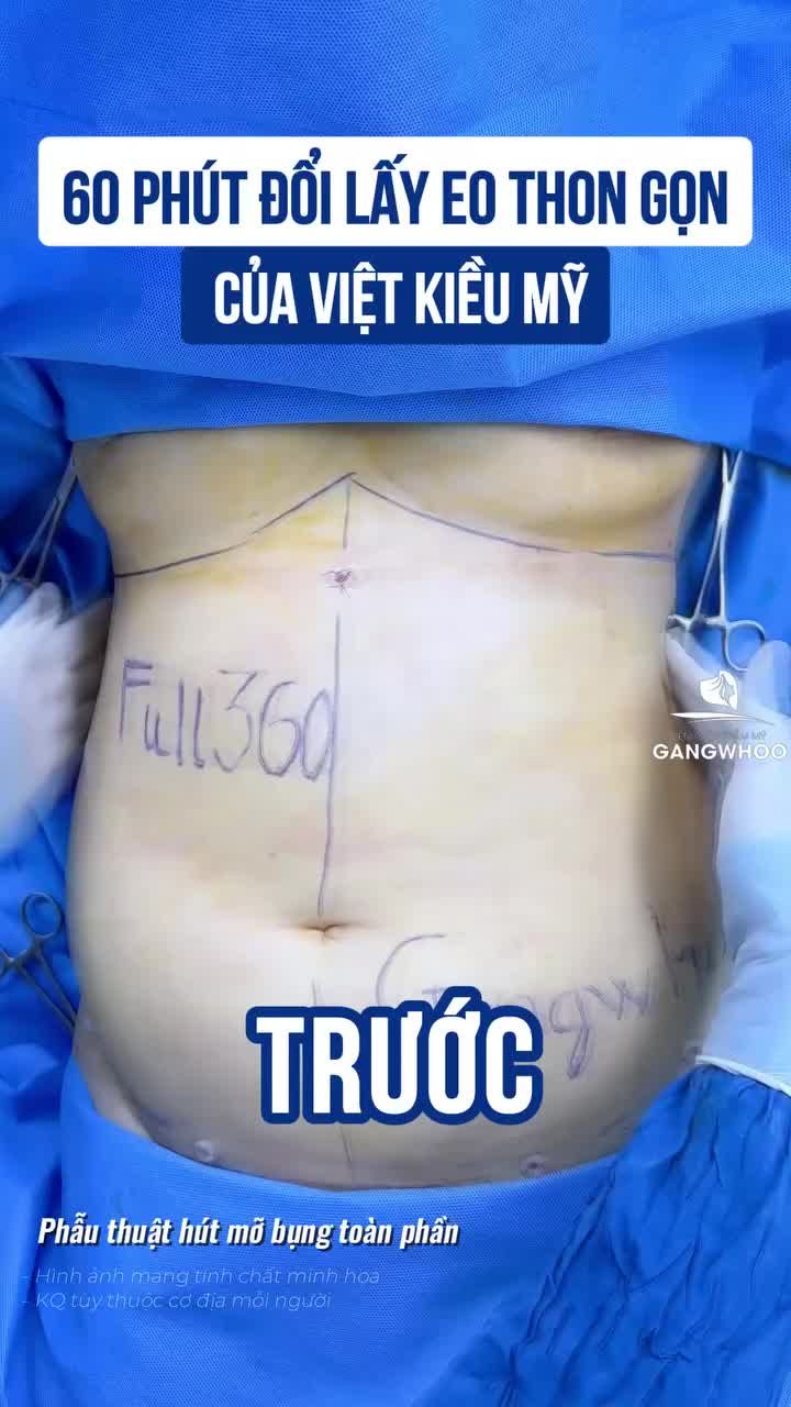 60 phút đổi lấy vòng eo mơ ước của Việt kiều Mỹ