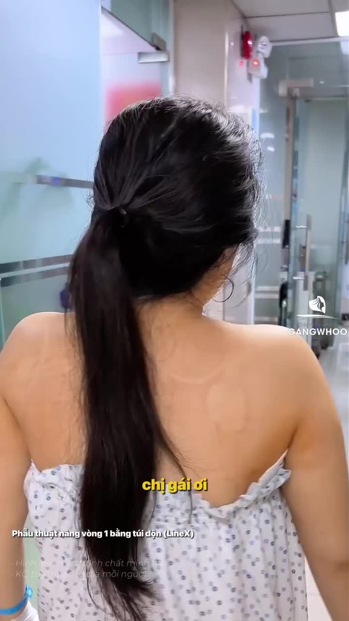 Trộm vía khách hàng mới nâng ngực xong 3 tiếng không cảm thấy đau đớn, đi lại vô cùng khỏe khoắn