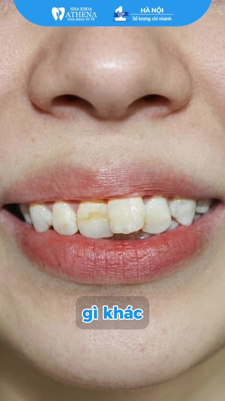 SẼ RA SAO NẾU NIỀNG RĂNG QUÁ TRỄ? Nhiều người luôn nghĩ: