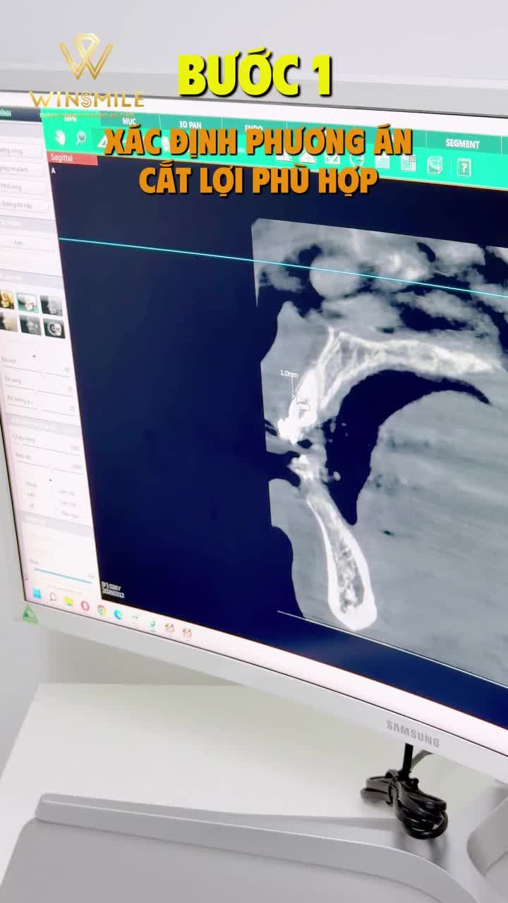 CHẠM ĐẾN NỤ CƯỜI CÂN ĐỐI CHỈ SAU 15 PHÚT CẮT LỢI