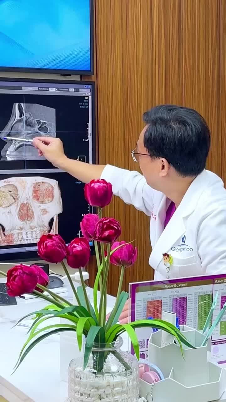 TƯ VẤN SỬA MŨI TÁI CẤU TRÚC: GIẢI QUYẾT TÌNH TRẠNG ĐẦU MŨI NGẮN LỘ SỤN CŨ