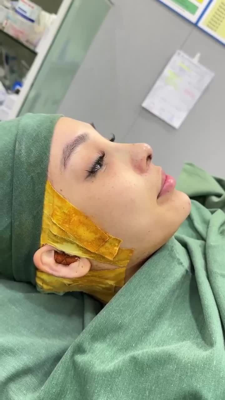 TRẢ KẾT QUẢ SAU 60 PHÚT THỰC HIỆN NÂNG MŨI CẤU TRÚC DR. HOẠT