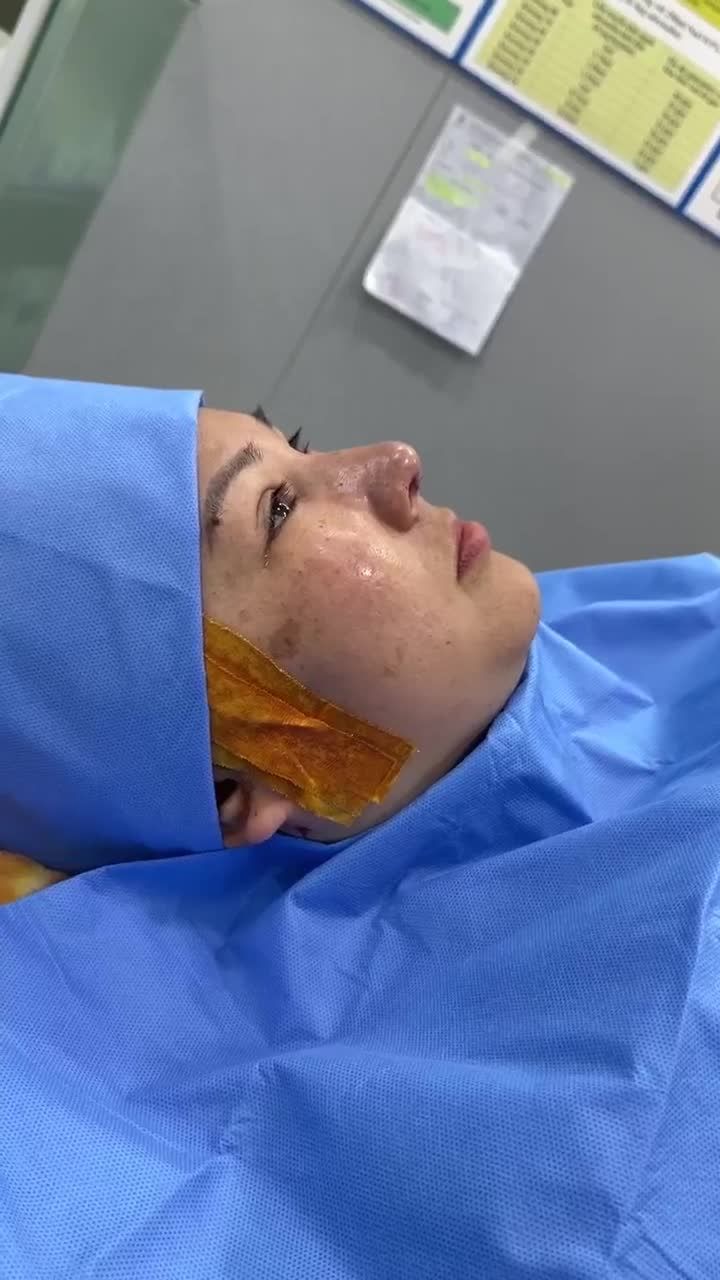 KẾT QUẢ XỬ LÝ FILLER - NÂNG CAO DÁNG MŨI KH. MỸ DUYÊN (NINH THUẬN)