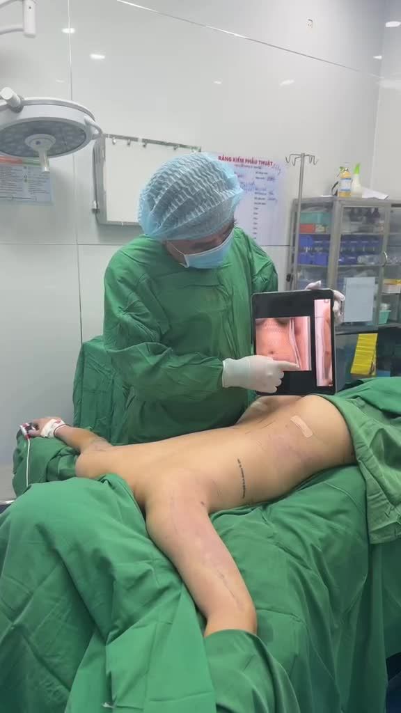 Combo ngày 14/3/2026: hút mỡ cánh tay-nách và hút mỡ bụng-siết eo với Dr Vương !