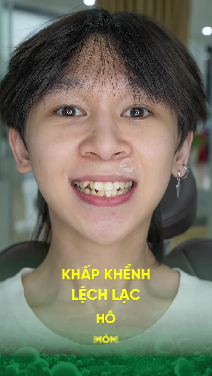 ĐỪNG ĐỢI ĐẾN KHI MUỘN RỒI MỚI ĐI NIỀNG RĂNG NIỀNG CÀNG SỚM - RĂNG CÀNG ĐẸP