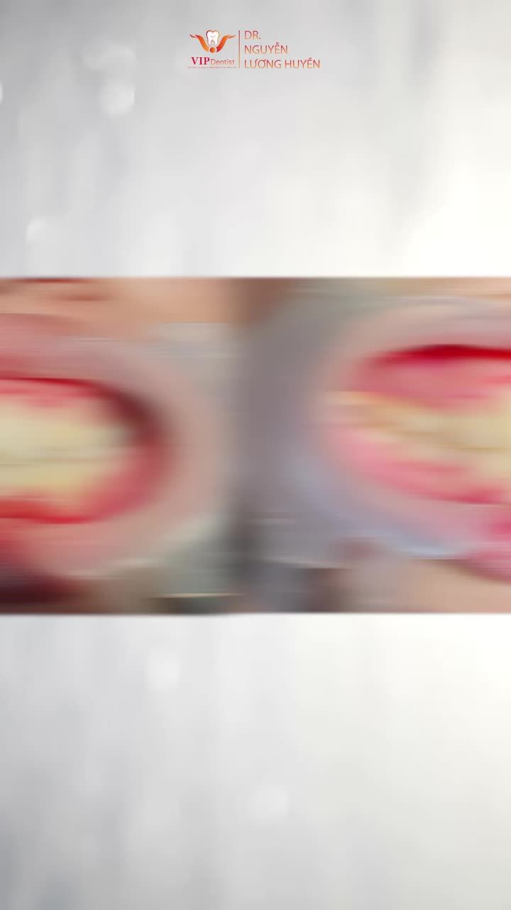 Tình trạng răng khấp khểnh nặng..