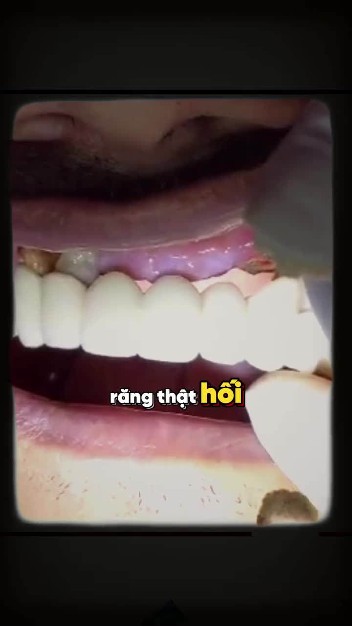 NHỮNG TRƯỜNG HỢP NÀO NÊN BỌC SỨ THẨM MỸ?