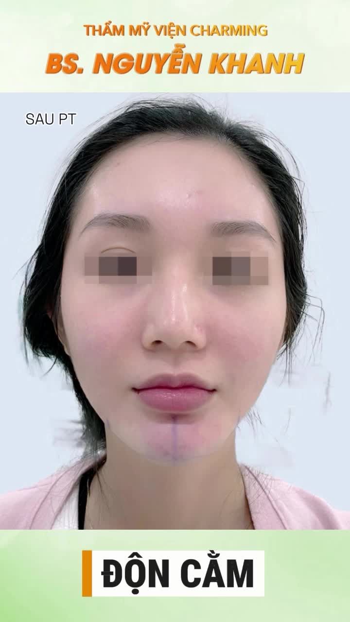 Nâng tầm nhan sắc không cần "dao kéo" quá đà, đôi khi chỉ cần một chút thay đổi ở chiếc cằm lẹm: