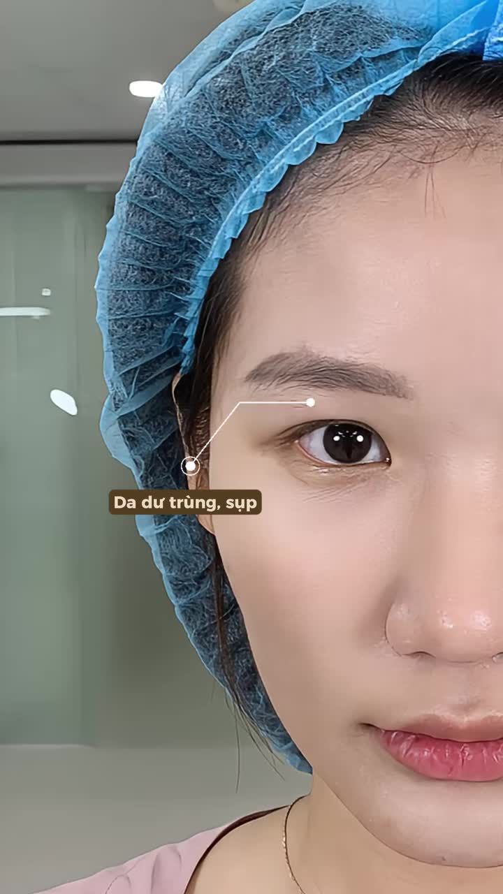 Tạm biệt đôi mắt sụp mí ngày nào, chào đón phiên bản rạng rỡ hơn của mình. Cùng xem hành trình làm mắt của Yến Nhi tại TMV Tấm.