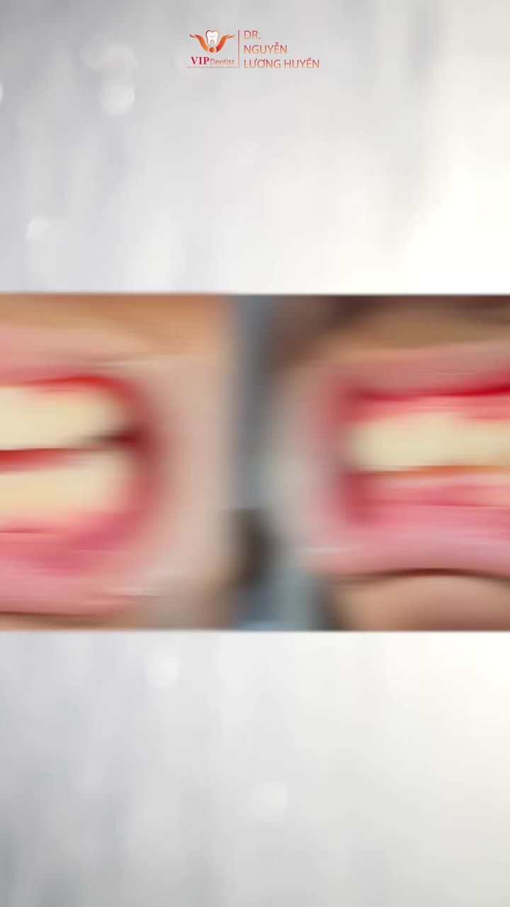 Kết quả niềng răng hô chìa với phác đồ Niềng Không Nhổ Răng tại VIP Dentist.