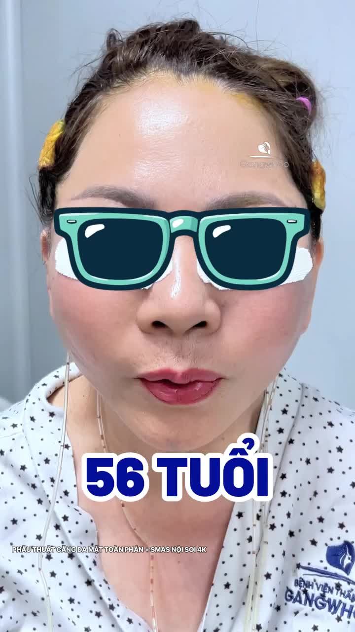 Feedback chân thật của chị khách hàng Úc sau khi thực hiện phẫu thuật căng da mặt toàn phần + Smas nội soi 4K