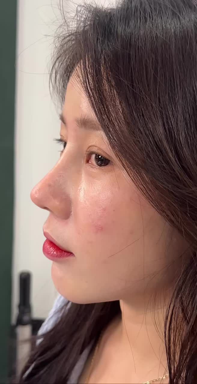 Nâng mũi cấu trúc sửa lại - Dáng mũi sau 2 tháng  tái khám!!