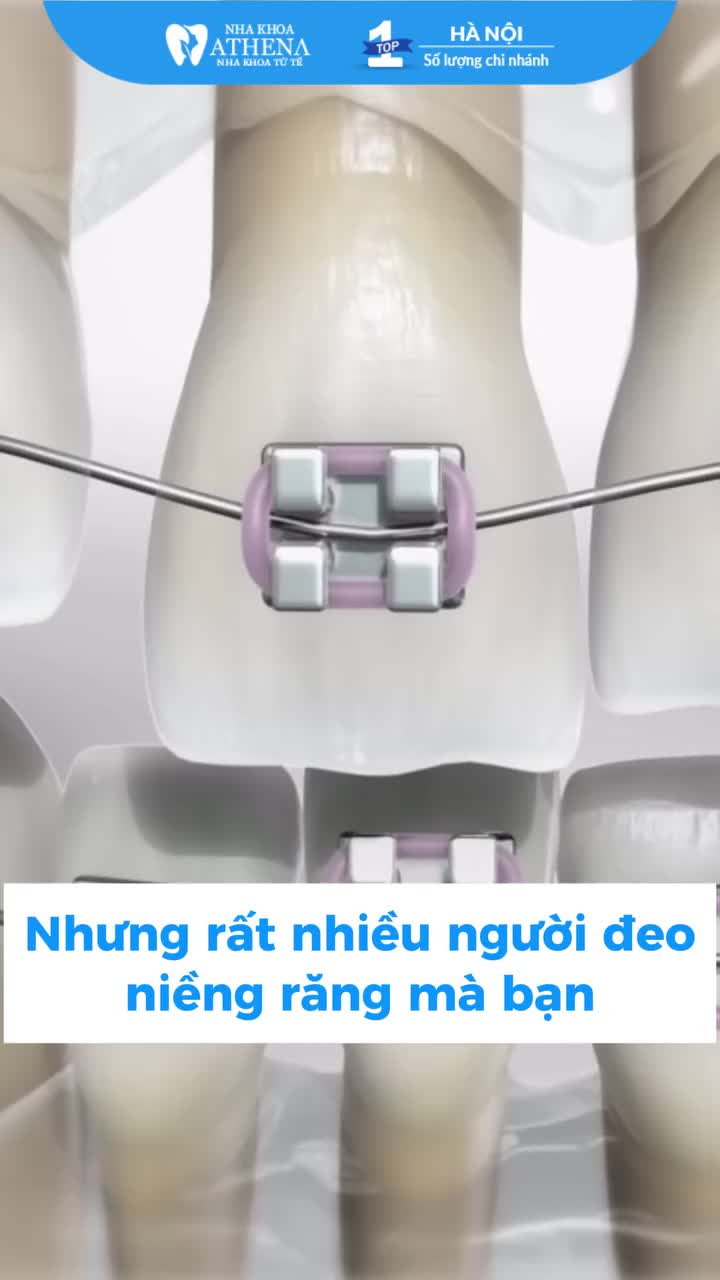 Niềng răng có những loại nào?