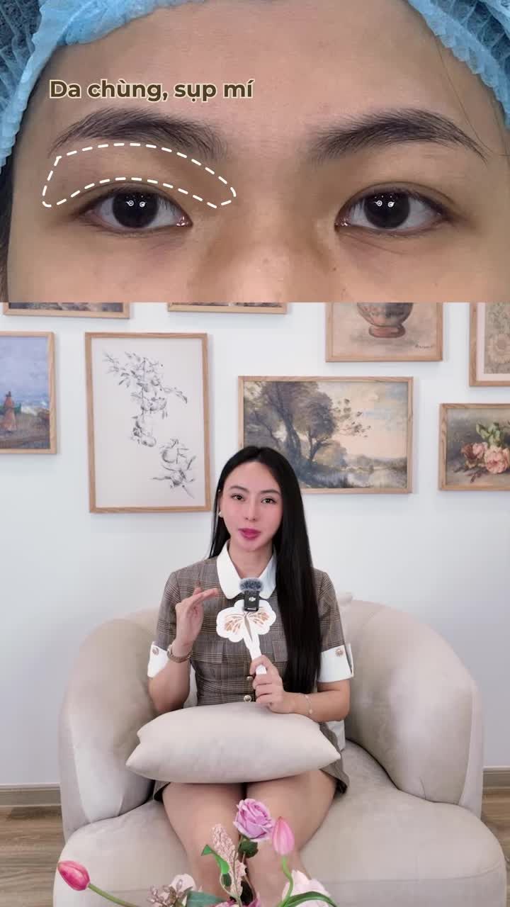 Mặc dù đã nhấn mí 1 năm ở cơ sở khác nhưng mí vẫn sụp do da chùng nhiều, nếp rẻ quạt, đuôi mắt ngắn và hẹp…