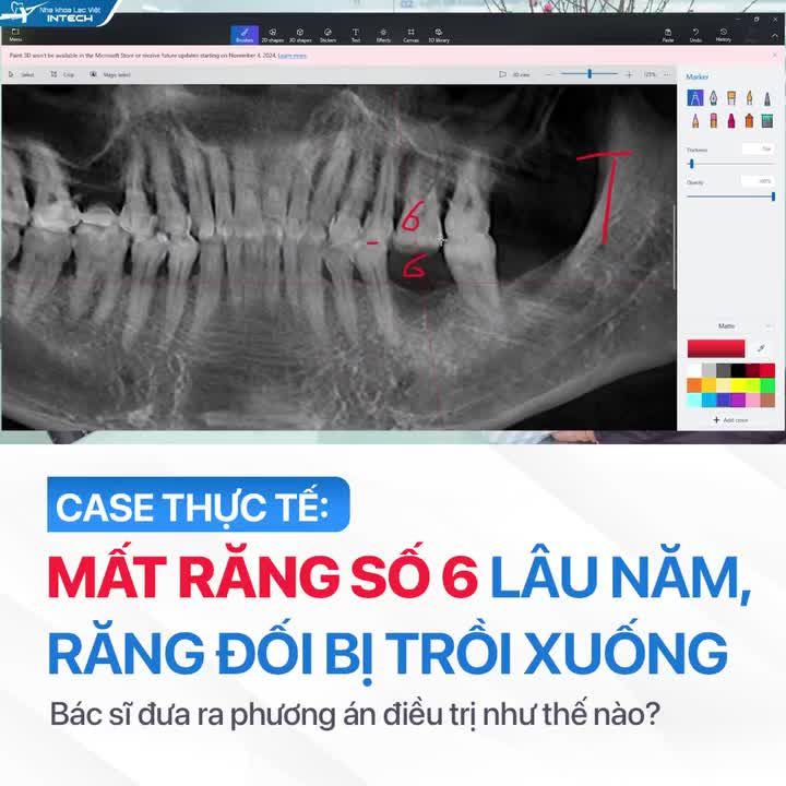 MẤT RĂNG SỐ 6 LÂU NĂM, RĂNG ĐỐI DIỆN BỊ TRỒI XUỐNG - XỬ LÝ NHƯ THẾ NÀO?